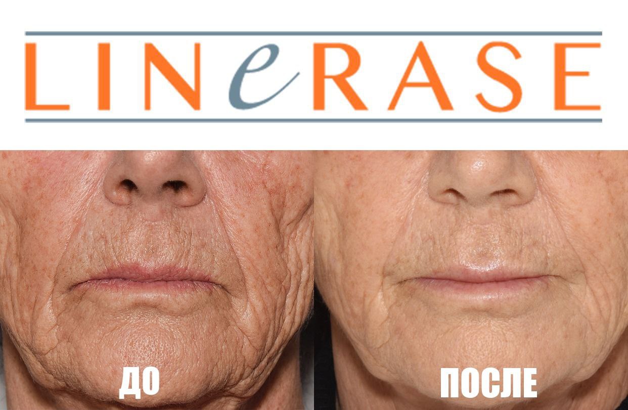LINERASE: фотоматериалы до и после