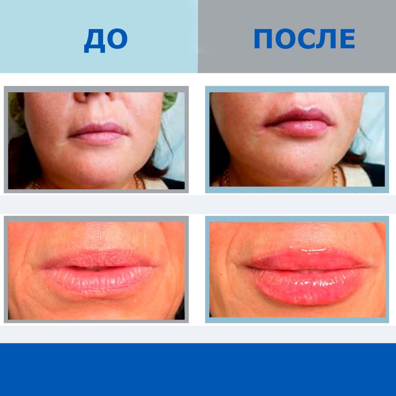 Коррекция губ: фотоматериалы до и после