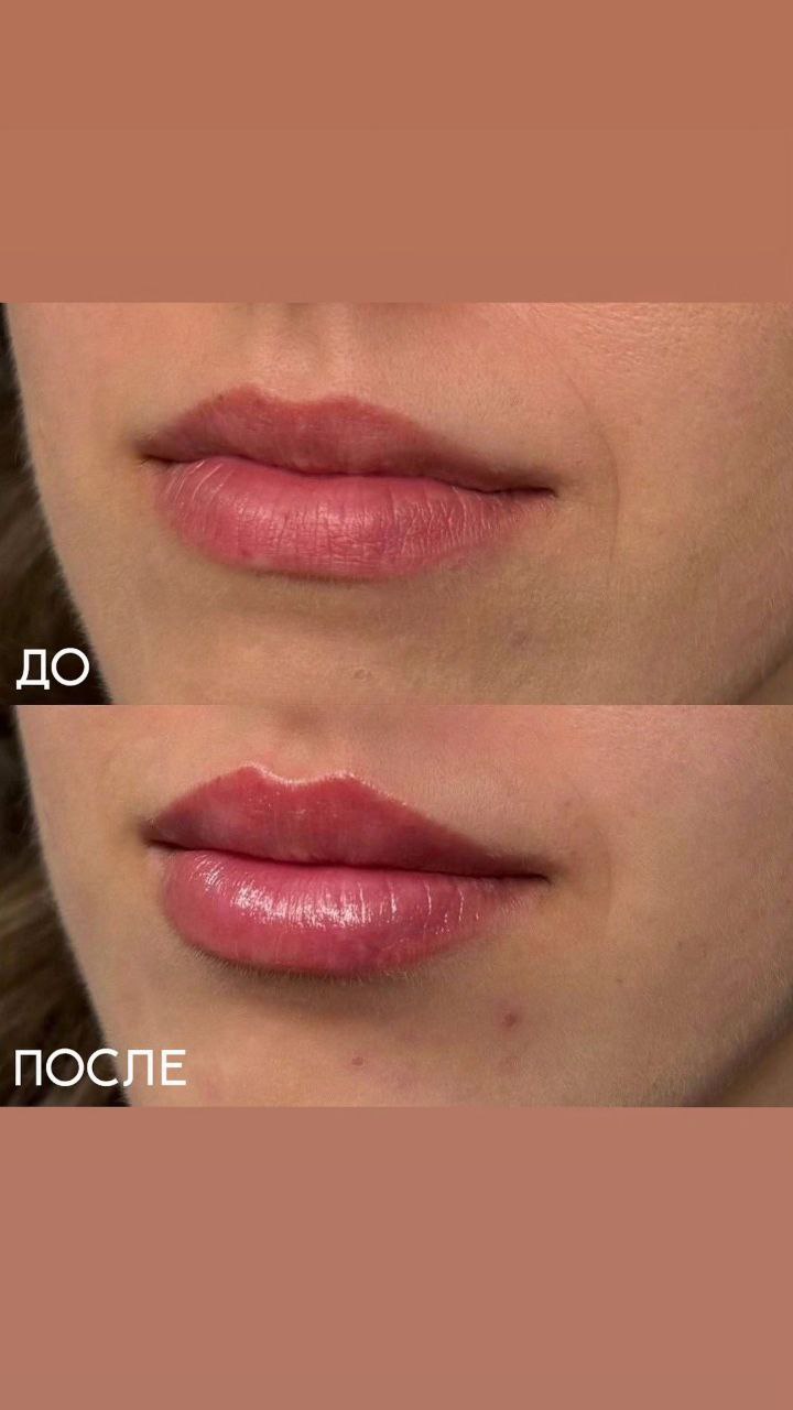 Коррекция губ: фотоматериалы до и после