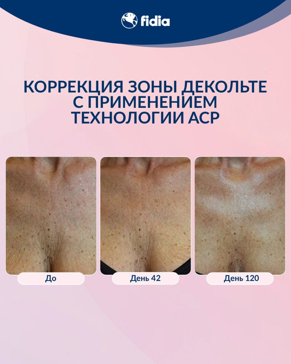 КОРРЕКЦИЯ ЗОНЫ ДЕКОЛЬТЕ С ПРИМЕНЕНИЕМ ТЕХНОЛОГИИ ACP